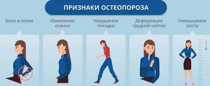 Что такое остеопороз и как с ним бороться, гимнастика от остеопороза