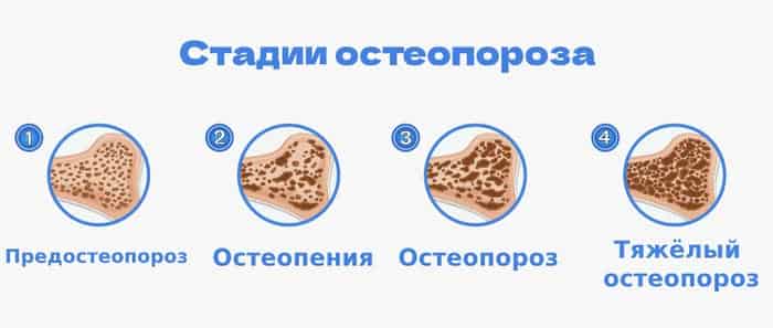 Что такое остеопороз и как с ним бороться, гимнастика от остеопороза