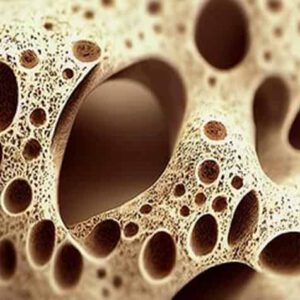 Что такое остеопороз и как с ним бороться?
