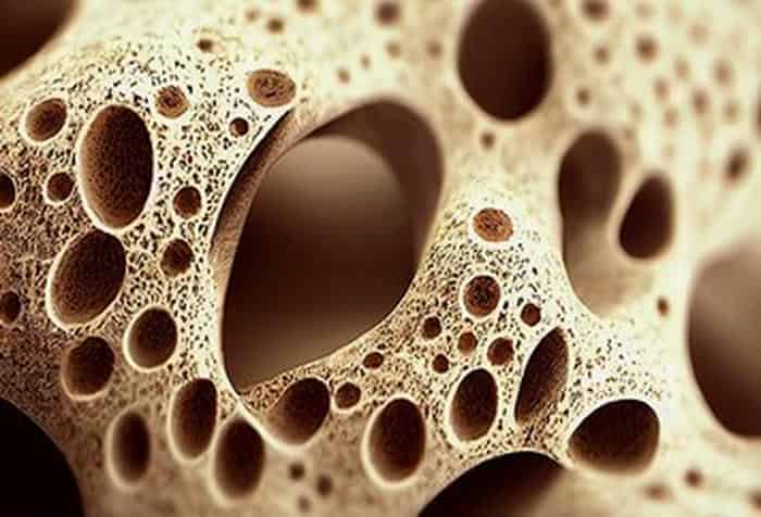 Что такое остеопороз и как с ним бороться, гимнастика от остеопороза